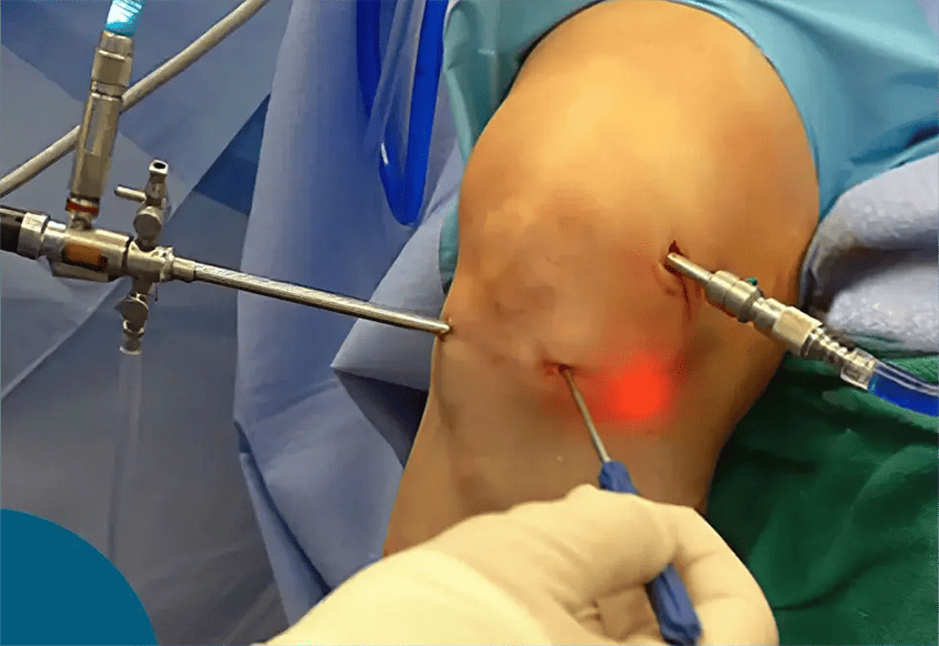  خدمات جراحة الركبة 